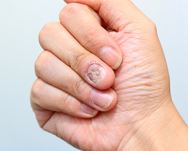 Онихомикоз или грибковое поражение ногтевых пластин